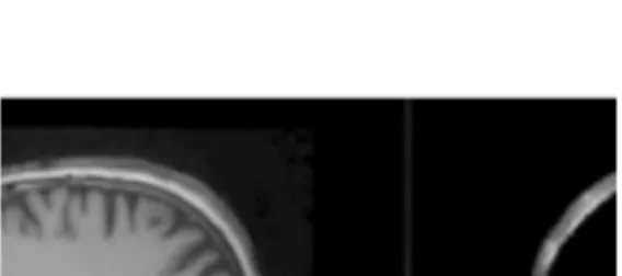 Figure 2: Extraction of the VOI on the T1 image (right) and UTE image masked with the VOI.