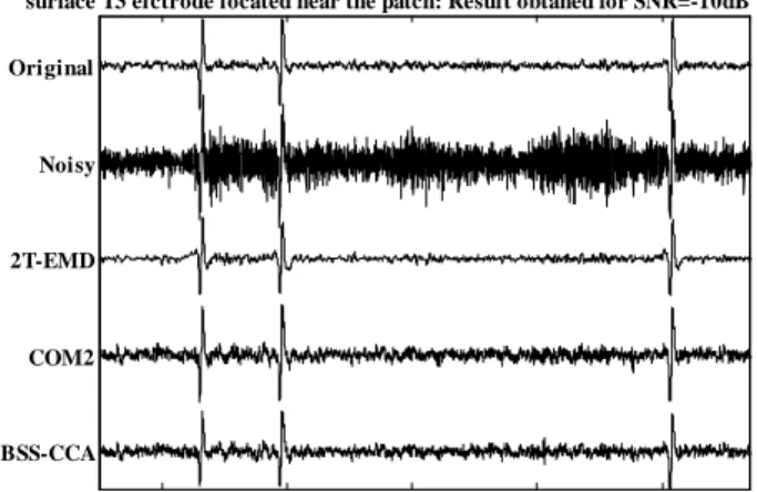 Figure  1  shows  the  results  obtained  at  the  surface  electrode  T3,  (facing  the  patch)  in  the  case  of   SNR=-10dB
