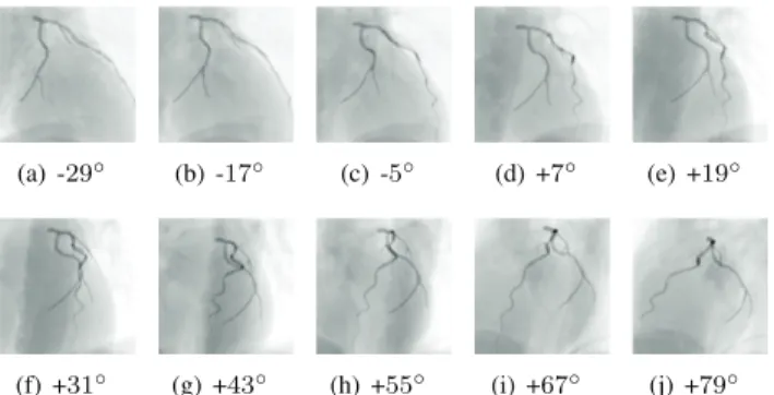 Fig. 6. The in-plane displacement comparison between real data (solid line) and simulated data (dashed line) for LAD-LCx (left) and OM-LCx bifurcation (right) marked in Fig