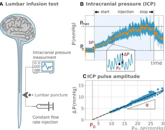 Fig. 2    Lumbar infusion test,  typical intracranial pressure  measurements and analysis