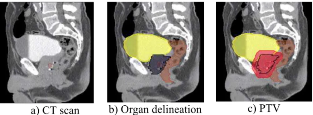 Figure 2. Sagittal views of CT scan delineation and definition of the Planned  Target Volume (PTV)