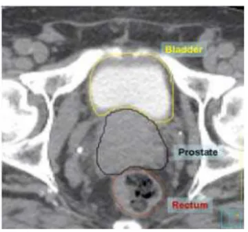 Figure 4. Axial view of manual segmentation of  bladder, prostate and rectum   overlaid on CT scan