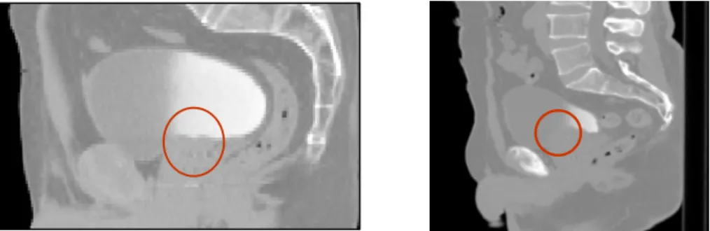 Figure 5.  Two examples of pelvic structures in CT (sagittal  views). The poor  contrast between structures hampers organ segmentation