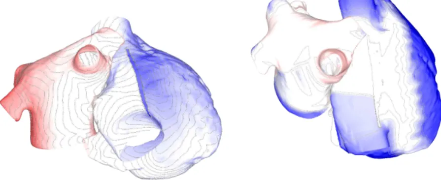 Figure 4: Left : posterior view of the activation map with 5 ms isolines.