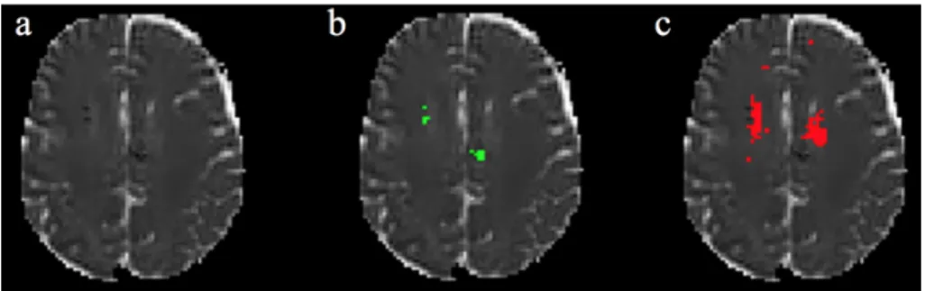 Figure 6. Failed cases. Case 8. a: MD image; b: Staple (3 raters); c: Automated method
