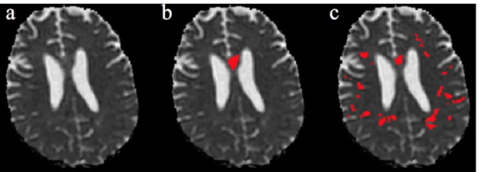 Figure 7. Failed cases. Case 9. a: MD image; b: Staple (3 raters); c: Automated method.