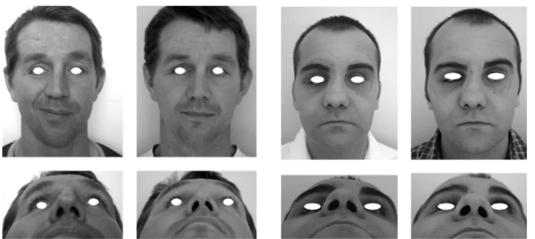 Fig. 10 : Patient 3. The postoperative pictures (top and centre bottom) show facial symmetry restoration whereas the preoperative CT scan  (bot-tom right and left) points out zygomatic displacement.