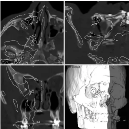 Fig. 1 : Native skull overimpressed with symmetrical skull computed from the controlateral healthy side around midsagittal plane.