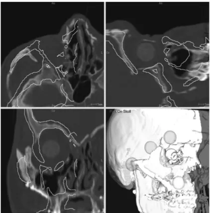 Fig. 2 : Result from the double registration of symmetrical skull to native skull according to selected surrounding ROI (spheres).