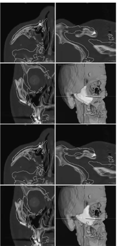 Fig. 3 : Segmented injured zygoma before (top) and after (bottom) registration to target skull.