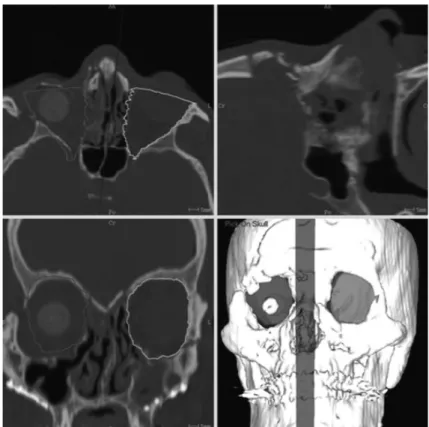 Fig. 5 : Planning for orbital reconstruction defined by symmetrical orbit from the healthy one around midsagittal plane.