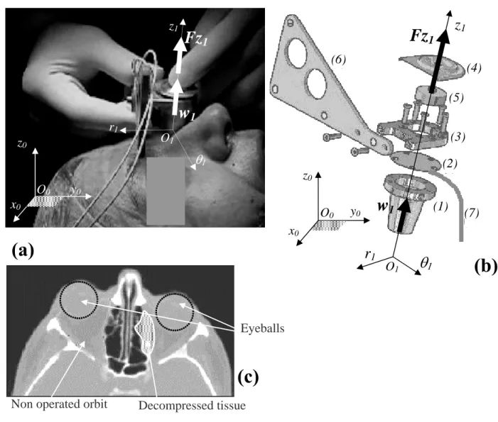 Figure 1 - Clinical procedure and experimental device: (a) intra-operative positioning; (b)  technological scheme: (1) aluminum conic base,  (2) stainless steel membrane involving  strain gages, (3) stainless ring, (4) stainless steel shell, (5) silicon cy