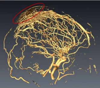 Figure 9 : Illustration of a plane-like structure (red ellipse) disturbing the segmentation on a brain MRA from the VIVABRAIN database.