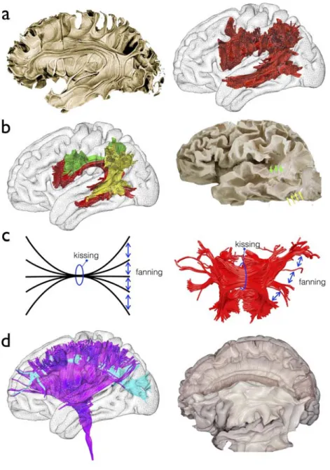 Figure 5: White matter anatomy from early tractography to advanced models. a)  Standard anatomical description of the arcuate fasciculus (Left panel,  104 ) replicated with  diffusion weighted imaging tractography (Right panel,  19 ) b) New anatomical mode