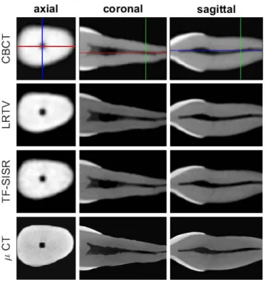Fig. 4. Results on Sample #1. In the rows the CBCT, LRTV output, TF-SISR output and µ CT images can be seen, whereas the columns correspond to one axial, a coronal and a sagittal slice