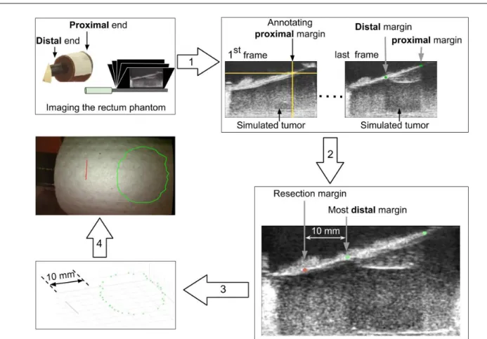 Fig. 10 Process of generating virtual model from US images: (1) marking the distal and proximal margins (green) of the simulated tumor on US images using crosshairs (yellow); (2) generating the resection margin (red) 10 mm below the most distal margin; (3)