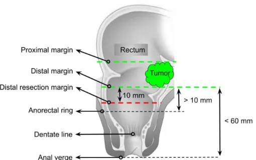 Fig. 1 Supra-anal tumor in rectum