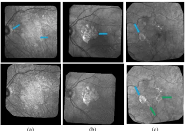 Fig. 1. Examples of cSLO fundus images, acquired in infrared from three  patients with dry ARMD