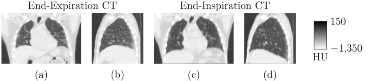 Figure 3: Patient Data – (a) Coronal and (b) sagittal view of the end-expiration CT image and (c) coronal and (d) sagittal view of the end-inspiration CT image, used to derive the attenuation maps in this study.