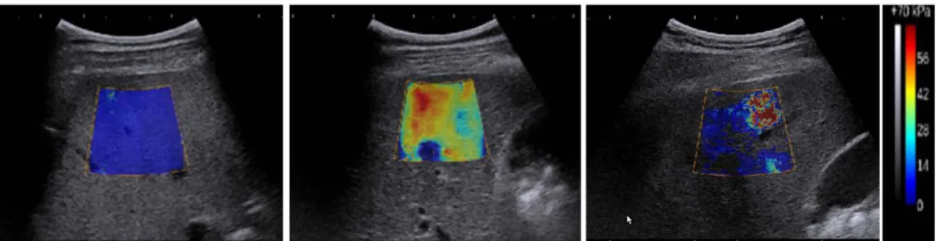 Fig. 1: SWE images of right livers accessed intercostally. a) Low spatial variation (SV=0.78) with high quality  elasticity map (PNF=0%); b) Heterogeneous spatial distribution (SV=4.11) with high filling (PNF  =0%), c)  Heterogeneous spatial distribution (