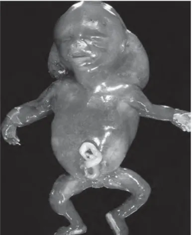 Figure 2 : Perte de grossesse 45,X au deuxième trimestre, avec hygroma kystique et un œdème généralisé [Solveig et Pflueger, 2005]