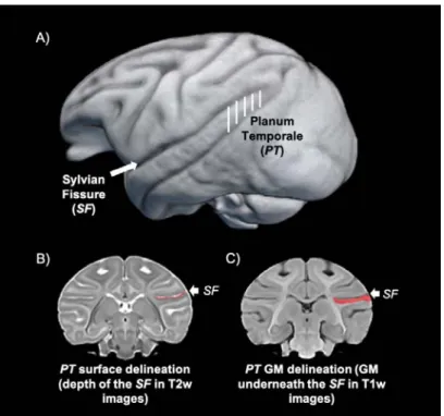 Figure 1. (A) 3D reconstruction of a newborn baboon brain with the PT region highlighted by the  75 