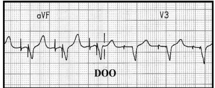 Fig. 5 Basic block diagram of ECG rhythm strip in DOO Operating Mode In our initial model, we have formalized the functional behaviors of the  car-diac pacemaker system , where two new variables P M Actuator A and P M Actuator V are represented ON or OFF s