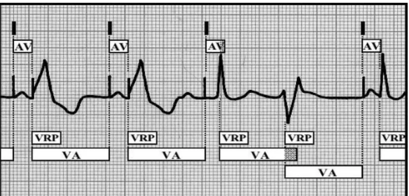 Fig. 6 Basic block diagram of ECG rhythm strip in DVI Operating Mode In the abstract model of DVI mode, two new variables (P M Actuator A) and (P M Actuator V ) represent the presence (ON) or absence (OFF) of pulse in atrial and ventricular chambers, respe