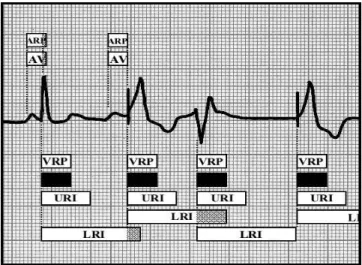 Fig. 8 Basic block diagram of ECG rhythm strip in VDD Operating Mode In this abstract model, we have formalized a bradycardia operating mode VDD of the double electrode pacemaker