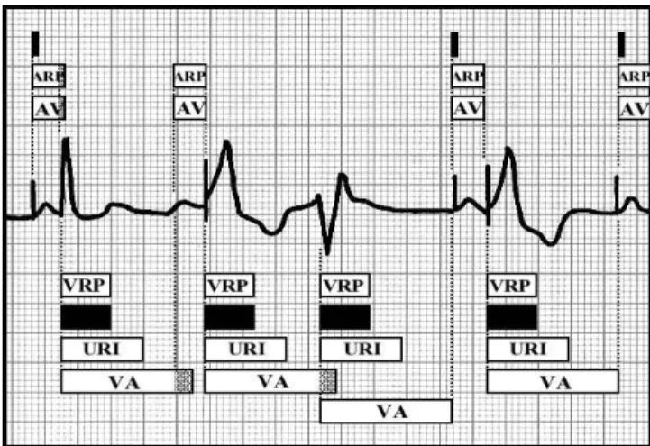 Fig. 9 Basic block diagram of ECG rhythm strip in DDD Operating Mode In this abstract model, we have formalized a bradycardia operating mode DDD of the double electrode pacemaker