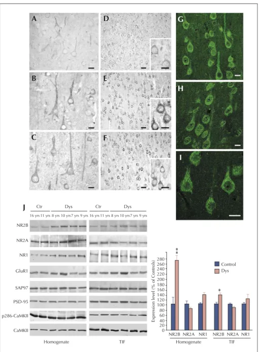 Figure 3. NMDA receptor expression and composition are altered in type IA FCD patients (from Finardi et al., 2006)