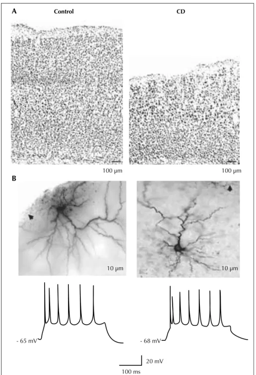 Figure 5. In utero irradiated rat model of cortical dysplasia. Pyramidal cells from the dysplastic cortex (CD) are spatially disorganized and dys- dys-play a regular spiking pattern to suprathreshold current pulses