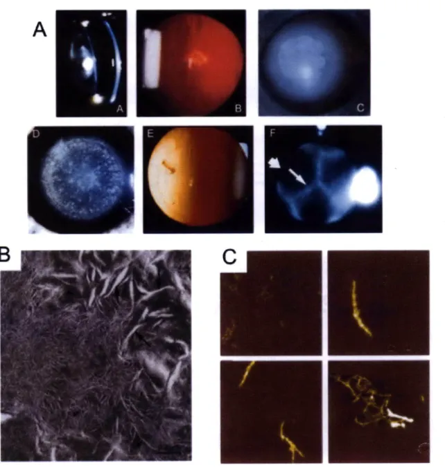 Figure  1-7:  Gross cataract  and  protein  aggregate  phenotypes.  (A)  A variety  of  cataracts  presented  by  patients  afflicted  with  congenital cataracts
