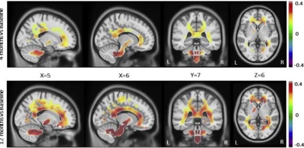 Table S8). Decreased plasma IL-6 concentrations were signi ﬁ cantly related to increased WM density in cerebellar peduncle and  spinothala-mic tract (p  0.0012, Table S8)