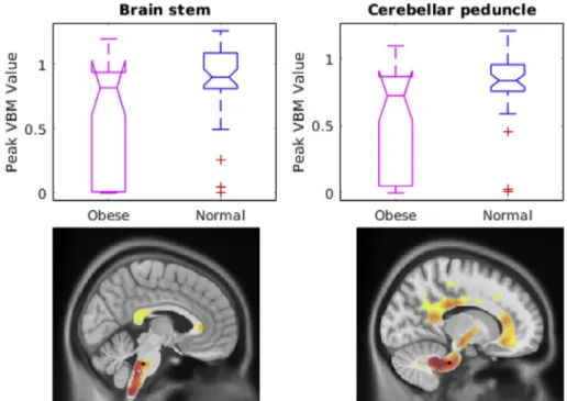 Fig. 5. Comparison of the peak Beta value in cerebellum between individuals with severe obesity and those who had normal body weight (p &lt; 0.0001)