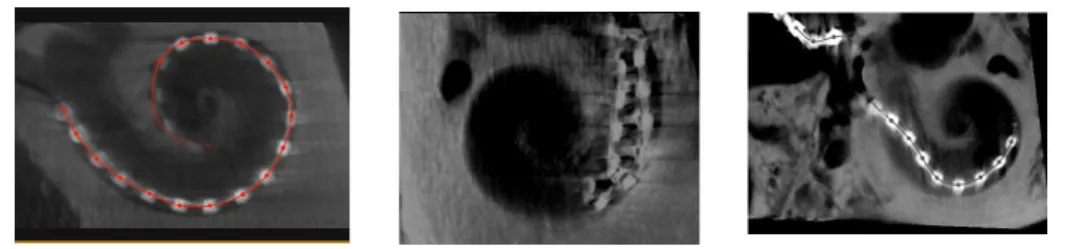 Fig. 1. Examples of 3 insertions with different outcomes, from left to right: successful insertion, failed insertion (folding tip), incomplete insertion.