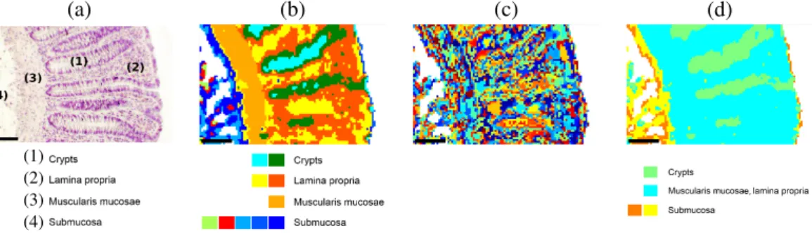 Figure 1: Comparison between conventional histology and pseudo color-coded images reconstructed by double CVI applica- applica-tions for patient sample 1