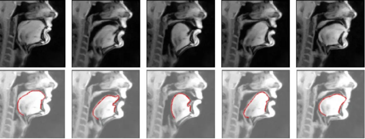 Figure 1. Results of automatic tongue delineation. Top row represents original images, bottom row shows the same images with the automatically detected tongue contour