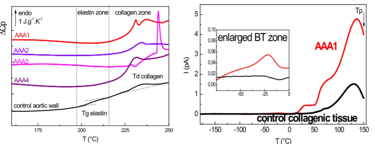 Figure 3. Thermal (A: DSC) and dielectric (B: TSC) characterization of human atheroma plaquesA