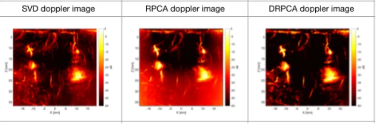 Fig. 4. The power doppler images of brain by respectively SVD, RPCA, DRPCA