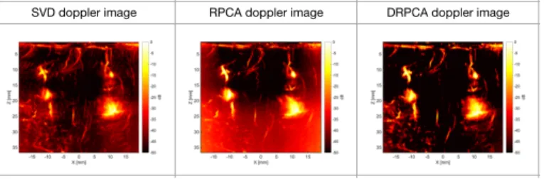 Fig. 4. The power doppler images of brain by respectively SVD, RPCA, DRPCA