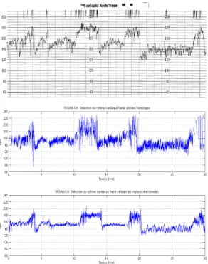 Figure 10 – Rythme cardiaque fœtal final fusionn´ ee : a) r´ ef´ erence Oxford SONICAID ; b) utilisant l’enveloppe ; c) utilisant les signaux directionnels