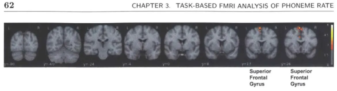 Figure  3.12:  Coronal  view  of  limbic  activations  with  sentence  valence.  L 1  contrast: