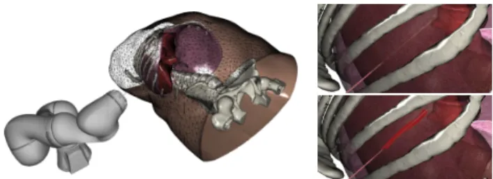 Figure 2: External view of the needle insertion with robotic as- as-sistance simulation (left)