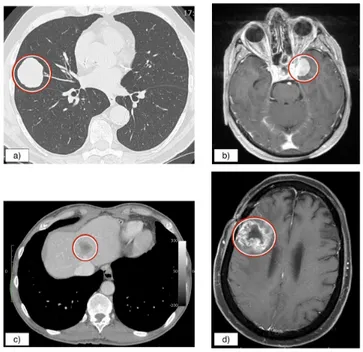 Figure 1: a) metastasis to the lung 1 , b) brain meningioma 2 , c) GIST metastasis to the liver 1 , d) brain glioma 3 .