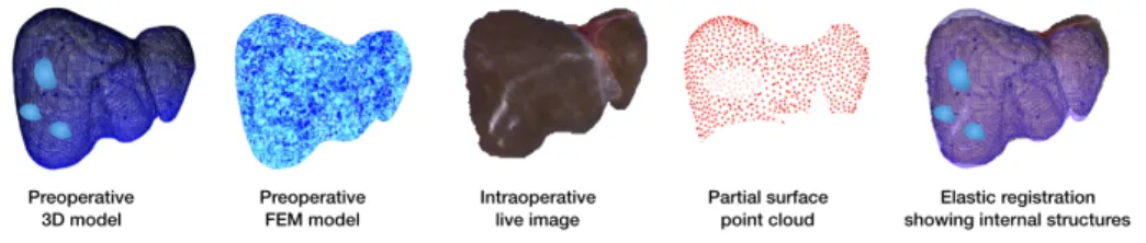 Fig. 1. Augmented reality pipeline: preoperative internal structures are mapped in real-time onto the live image of the organ using a FEM model.