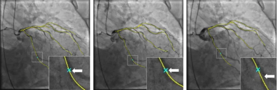 Fig. 2: Tracking results for one patient over one cardiac cycle. The yellow curve represents the projected 3D vessel, the blue cross represents the point tracked as the bifurcation, and the white arrow points to the bifurcation