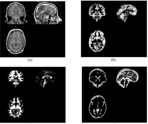 Figure 2: Segmentation of pre-operative MR image (a)  in grey matter (b), white matter (c), and cerebrospinal fluid (d) 