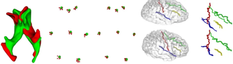 Fig. 3. Experiments on real data. Ventricles: From left to right : X (green) and A(Y ) (red) before registration, position of the 8 anatomical landmarks of the 10 random experiments after registration without priors/constraints and with priors/constraints.