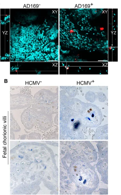 Figure 6. dNK cells infiltrate infected placental tissues. (A) Two-color 3D-images of chorionic villi explants organ cultures established from first trimester trophoblast either uninfected (AD169 2 ) or HCMV-infected (AD169 + )